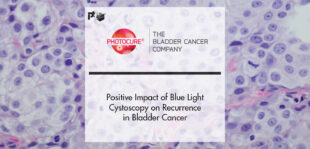 Positive Impact of Blue Light Cystoscopy on Recurrence in Bladder Cancer Presented at the Annual SUO Meeting | PTF